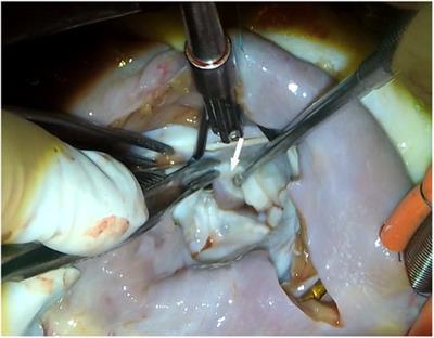 Anomalous papillary muscle insertion into the mitral valve leaflet in hypertrophic obstructive cardiomyopathy: a lip nevus sign in echocardiography